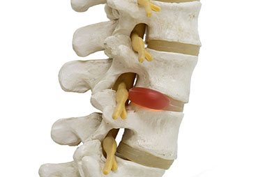 Herniated dsic