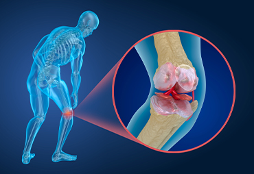 knee joint with osteoporosis