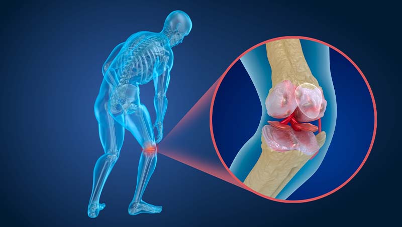 knee joint with osteoporosis