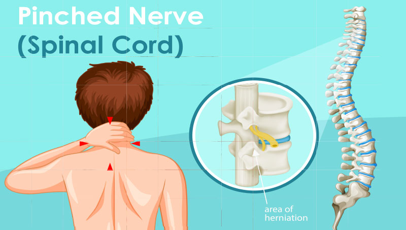 Pinched nerve pain in spinal cord